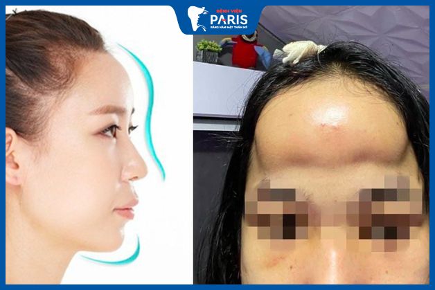 Các biến chứng độn trán khi làm tại địa chỉ không uy tín
