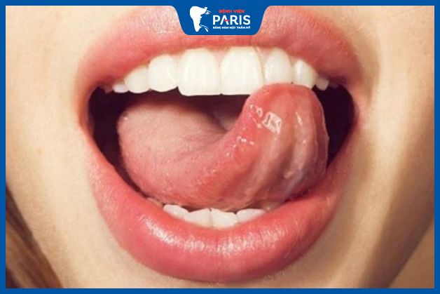 Cách chỉnh hô hàm tại nhà bằng lưỡi