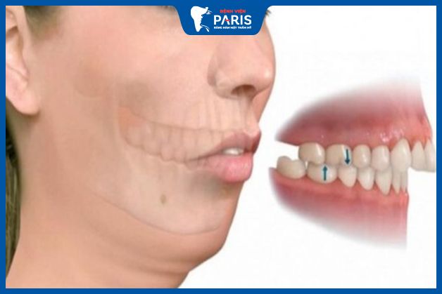Các phương pháp tại nhà không có hiệu quả với hàm hô