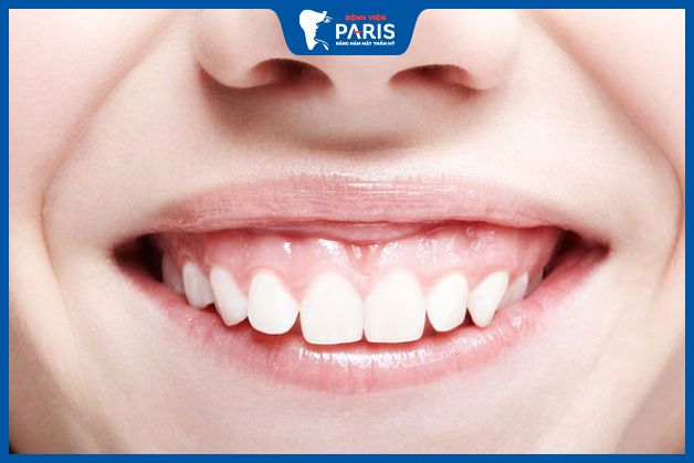 Hiện tượng cười hở lợi