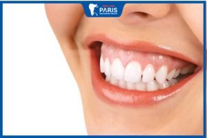5 cách chữa cười hở lợi tại nhà an toàn hiệu quả