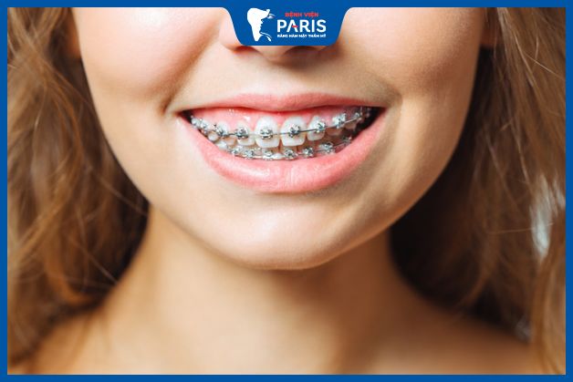 Niềng răng chữa cười hở lợi