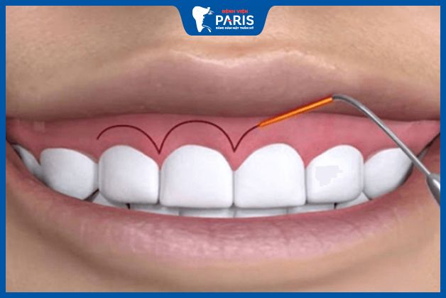 Phương pháp cắt nướu chữa cười hở lợi bằng tia laser