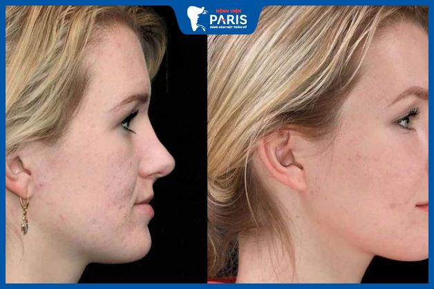 Cấy mỡ thái dương được bao lâu