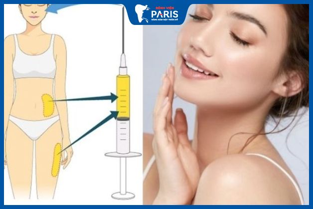 Đối với phương pháp độn cằm bằng mỡ tự thân