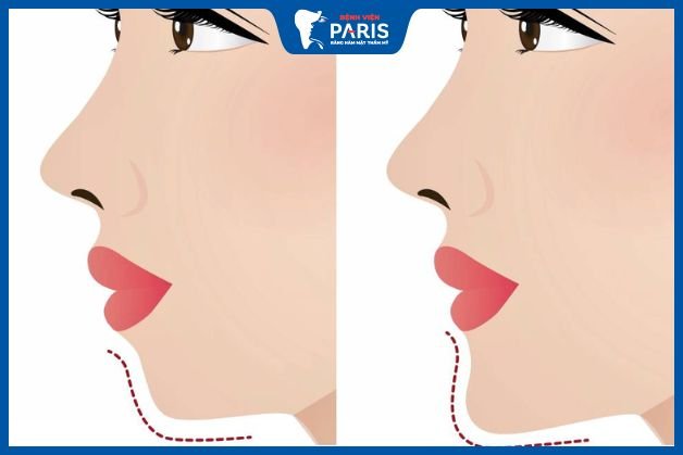Độn cằm giúp khắc phục cằm lẹm