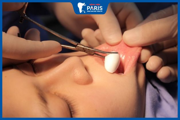 Độn cằm bao lâu hết sưng phụ thuộc vào bác sĩ