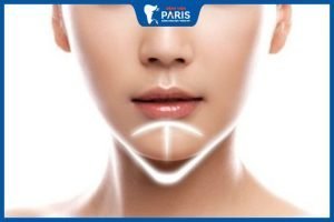 Độn cằm bao lâu hết sưng – 4 yếu tố ảnh hưởng bạn cần biết