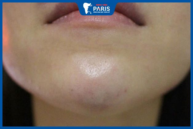 Sưng tấy kéo dài có thể là biến chứng độn cằm