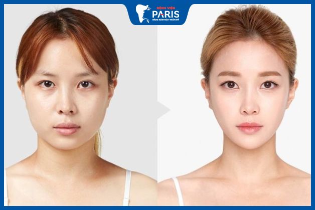Độn cằm bao lâu thì lành