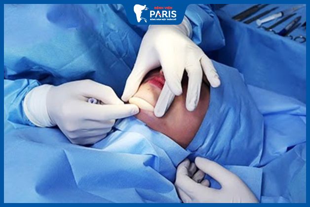 Bác sĩ độn cằm cần có chuyên môn cao