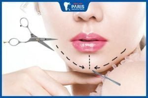Độn cằm giữ được bao lâu – Những yếu tố ảnh hưởng đến