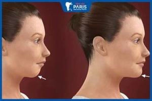 Độn cằm lẹm: Các phương pháp thực hiện và chi phí cần biết
