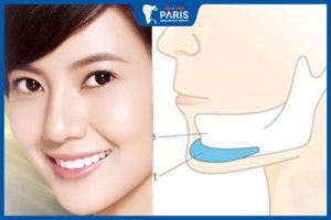 Độn cằm silicon là gì? Ưu, nhược điểm của độn cằm silicon