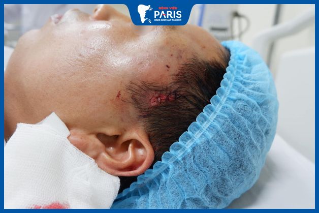 Biến chứng nhiễm trùng sau khi độn thái dương