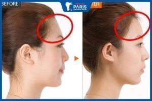 Độn trán có nguy hiểm không? Những biến chứng có thể gặp phải