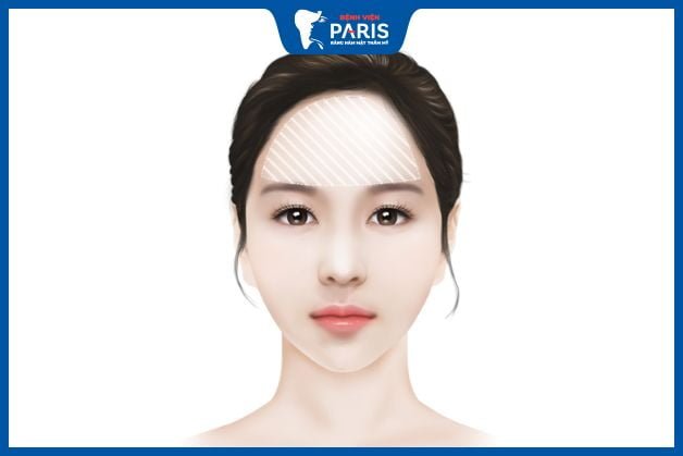 Độn trán có nguy hiểm không