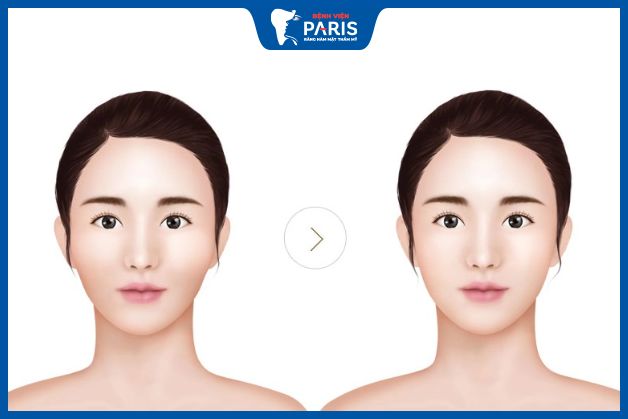 Hạ gò má giúp gương mặt mềm mại và cân đối
