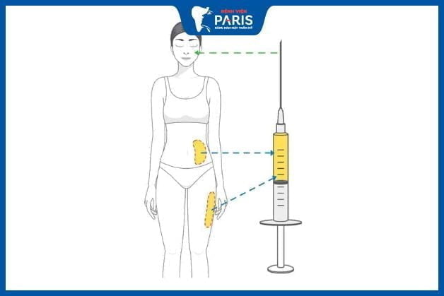 Hiểu rõ về độn thái dương bằng mỡ tự thân