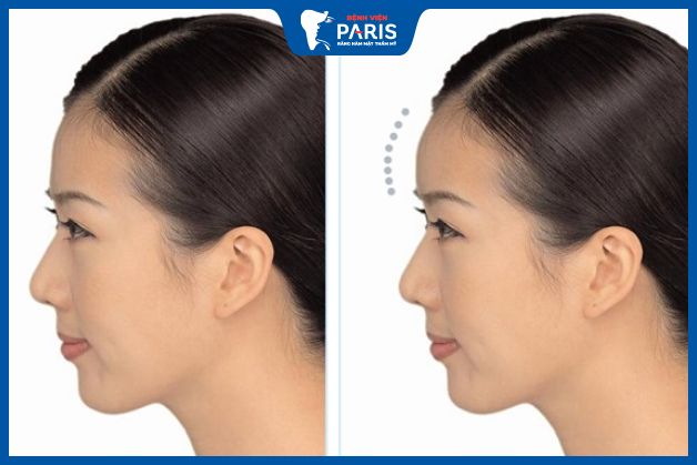 Mục đích độn trán