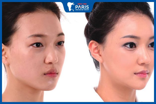 Những ai nên làm đầy thái dương bằng mỡ tự thân
