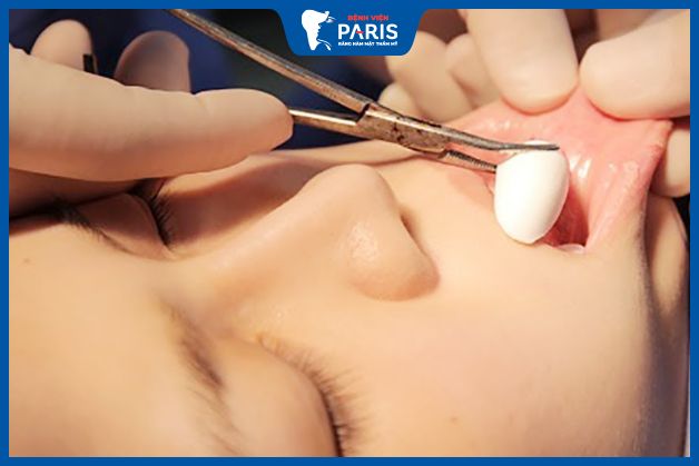 Mức độ đau nhức sau khi độn cằm phụ thuộc vào chuyên môn của bác sĩ