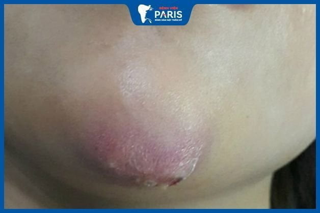 Đau nhức kéo dài có thể là dấu hiệu của biến chứng nhiễm trùng sau độn cằm