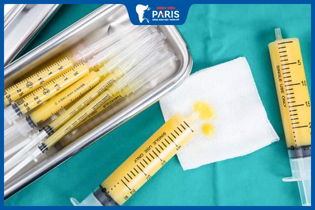 Quy trình cấy mỡ tự thân độn thái dương