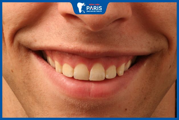 Đàn ông cười hở lợi thường gặp lận đận trong cuộc sống