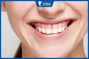 Người răng ngắn cười hở lợi tướng số ra sao – Giải pháp cải tướng
