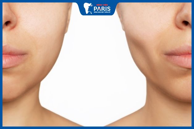 Chăm sóc sau tiêm sai cách khiến má bị hóp