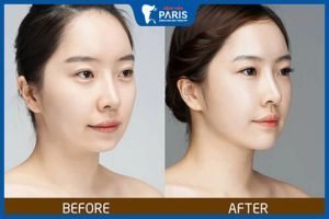 Tổng hợp những kinh nghiệm độn cằm “đắt giá” dành cho bạn