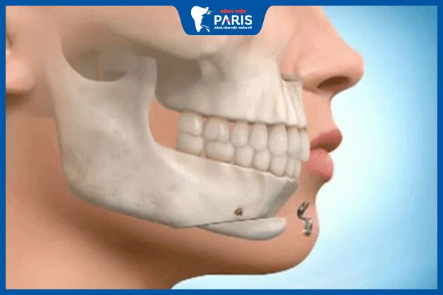 Trượt cằm có nguy hiểm không