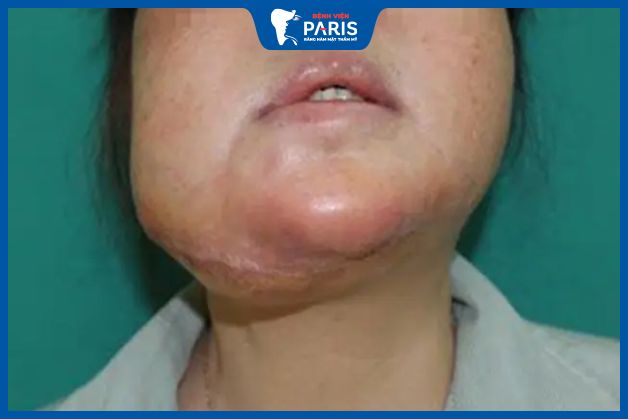 Biến chứng khi trượt cằm giá rẻ