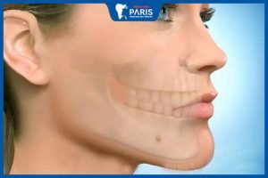Trượt cằm có nguy hiểm không – Các biến chứng sau trượt cằm
