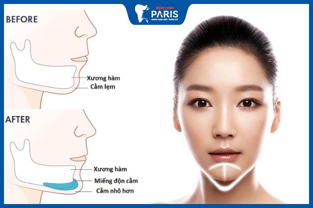 Ưu – Nhược điểm của độn cằm bằng silicon