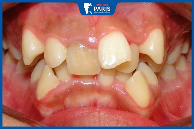 Hàm lệch do các răng trên cung hàm mọc lộn xộn