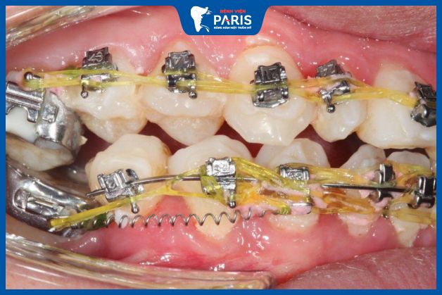 Niềng răng sai cách có thể làm hàm răng bị sai lệch nghiêm trọng hơn