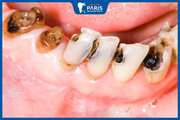 Lệch hàm làm răng nguy cơ bị sâu răng