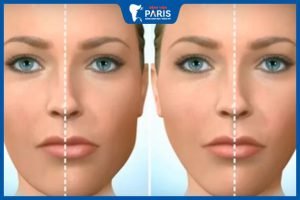 Tổng hợp các cách chỉnh hàm lệch hiệu quả, an toàn bạn cần biết