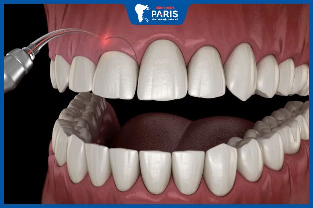 Chữa cười hở lợi bằng phương pháp cắt nướu