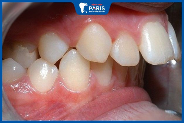 Cười hở lợi do xương hàm trên quá phát cần phẫu thuật nắn chỉnh xương