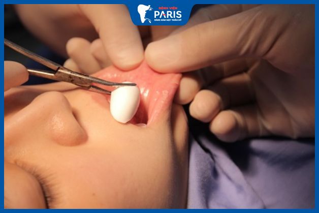 Bác sĩ độn cằm sai kỹ thuật có thể gây đau nhức kéo dài