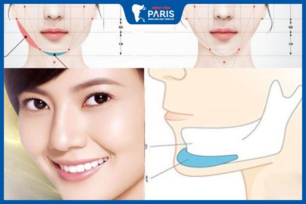 Độn cằm bằng sụn nhân tạo