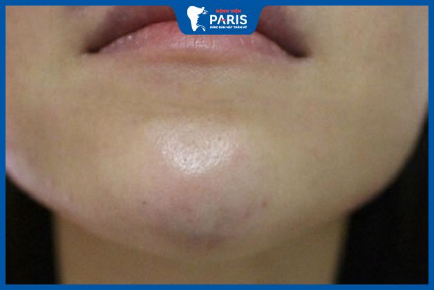 Độn cằm bị bao xơ là gì