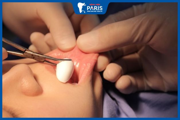 Độn cằm bị tụ dịch do bác sĩ thực hiện sai kỹ thuật