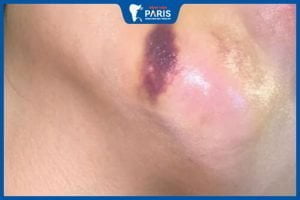 Độn cằm bị tụ dịch: Nguyên nhân và cách xử lý hiệu quả