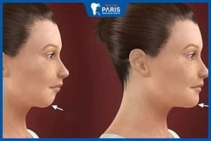 Độn cằm có giảm hô không? 4 phương pháp thực hiện
