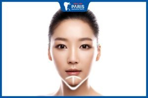 Độn cằm có phá tướng không, bí quyết độn cằm cực “đắt giá”