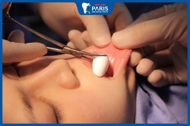 Độn cằm nghỉ dưỡng bao lâu – Phương pháp phẫu thuật